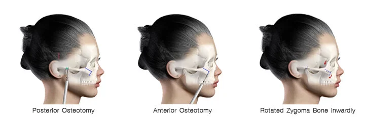 Cheekbone Reduction Surgery Costa Mesa CA Dr. K. Charles Kim